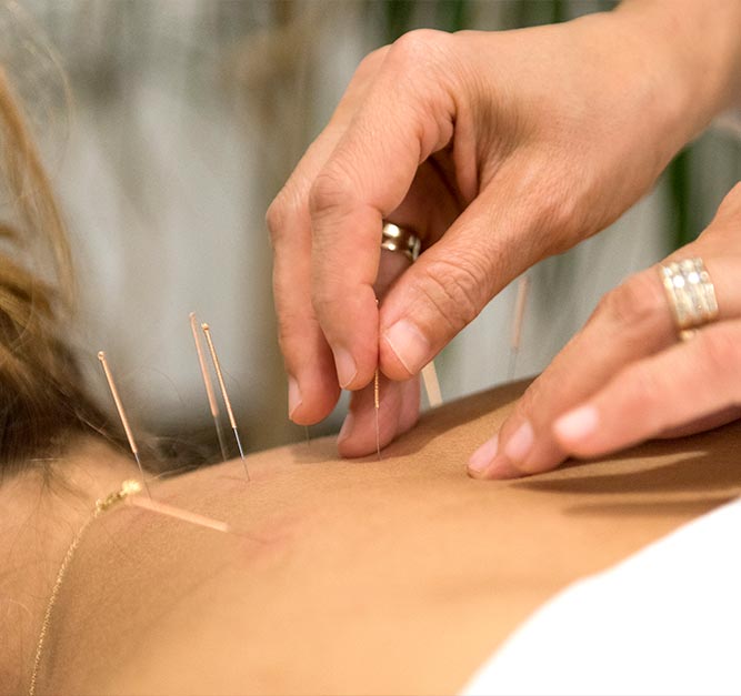 Acupuncture